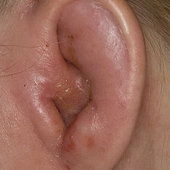 diffuzniyotitnaruzhnogouxafotosimptomiil F3011E35 - Диффузный отит наружного уха — симптомы и лечение