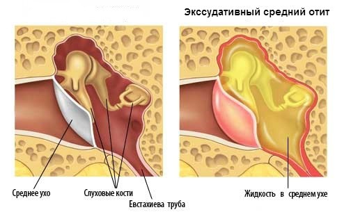 ekssudativniyotitprichinisimptomiilechen 265BFA51 - Экссудативный отит среднего уха (двухсторонний, левосторонний и правосторонний)