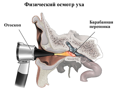 ekssudativniyotitsimptomiformitecheniele 37AECF97 - Экссудативный отит среднего уха (двухсторонний, левосторонний и правосторонний)