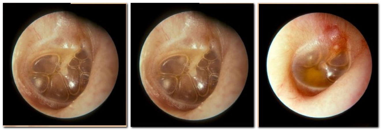 ekssudativniyotitsimptomiformitecheniele B7FB7119 - Экссудативный отит среднего уха (двухсторонний, левосторонний и правосторонний)