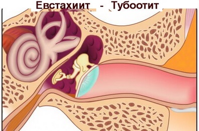 evstaxiitsimptomiilechenievdomashnixuslo FE74FCD4 - Лечение тубоотита и евстахиита в домашних условиях народными средствами