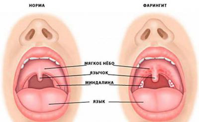 faringitilaringitotlichiyasimptomiimetod 53D035E6 - Пульсирует в ухе: причины стука и пульса в органах слуха, почему бьется в ухе пульс, но не болит?