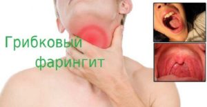 faringitkaklechituvzroslogoxronicheskiyf A81AB658 - Лечение фарингита народными средствами в домашних условиях