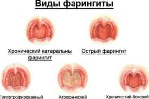 faringitkaklechituvzroslogoxronicheskiyf B2A5B09A - Аллергический отит: симптомы и лечение
