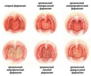 faringitostriyxronicheskiylechenieisimpt EA657F93 - Постоянные болячки в носу: причины, чем мазать, когда образовывается сухость и как вылечивать заболевание