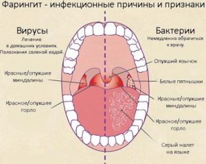 faringitpriberemennostikaklechitvliyanie 6F6FC505 - Причины и лечение сухого кашля, покашливания и постоянного першения в горле