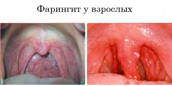 faringituvzroslixsimptomiisxemalecheniya 2536C02B - Фарингит, что это такое? Симптомы и лечение у взрослых