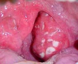 follikulyarnayaanginalecheniesimptomifot 1BA5055A - Фолликулярная ангина – это инфекционное заболевание, которое проявляется в виде воспаления небных миндалин