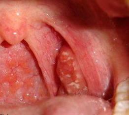 follikulyarnayaanginalecheniesimptomifot A82B3760 - Фолликулярная ангина – это инфекционное заболевание, которое проявляется в виде воспаления небных миндалин