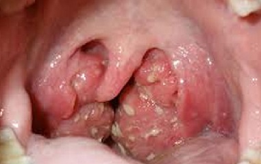 follikulyarnayaanginalechenievdomashnixu 5760F3DA - Фолликулярная ангина – это инфекционное заболевание, которое проявляется в виде воспаления небных миндалин