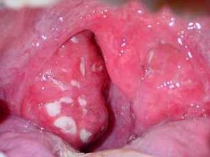 follikulyarnayaanginalechenievdomashnixu C3593406 - Фолликулярная ангина – это инфекционное заболевание, которое проявляется в виде воспаления небных миндалин