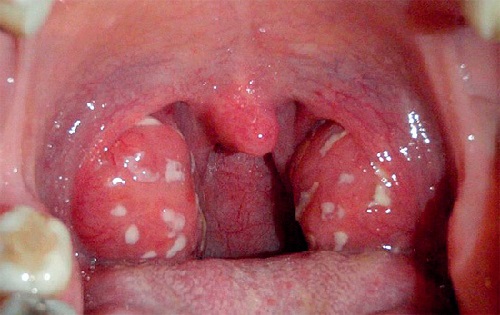 follikulyarnayaanginalechenievdomashnixu F88DF109 - Фолликулярная ангина – это инфекционное заболевание, которое проявляется в виде воспаления небных миндалин