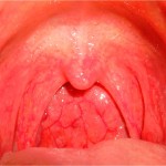 gipertroficheskiyfaringitsimptomilecheni 37B6E863 - Чем можно лечить больное горло при беременности 1 триместр