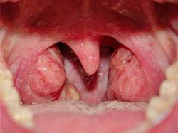gnoyniyfaringitprichinisimptomilecheniei 224E079F - Чем полоскать больное горло: почему оно может болеть, растворы для полоскания и полезные советы