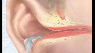 gnoyniyotitlechenieoslozhneniyastadii E5171C54 - Операция при отите среднего уха