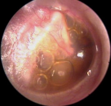 gnoyniyotitlechenieoslozhneniyastadii F866DE5D - Операция на ухо при хроническом гнойном отите