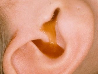 gnoyniyotiturebenka40fotosimptomipriznak 495CA1AB - Гнойный отит у ребенка (40 фото): симптомы, признаки и лечение острого гнойного отита и среднего уха в домашних условиях у новорожденного