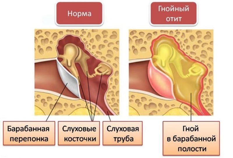 gnoyniyotiturebenkafotosimptomichemlechi AE8D3AD6 - Лечение фронтита у взрослых: как лечить хронический фронтит и острый