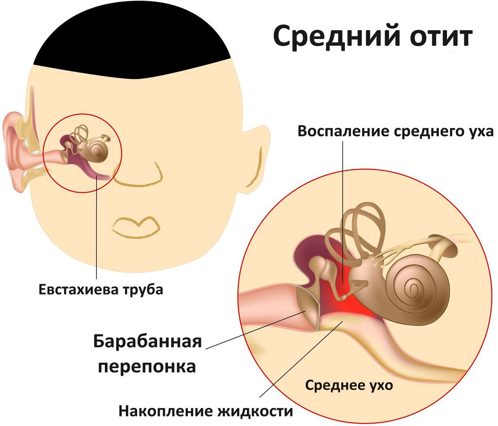 gnoyniyotituvzroslixlecheniepodrobnayain 424427EE - Гнойный отит: лечение у взрослых, симптомы и причины