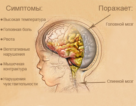gnoyniyotituvzroslixlecheniepodrobnayain BE836D12 - Гнойный отит: лечение у взрослых, симптомы и причины