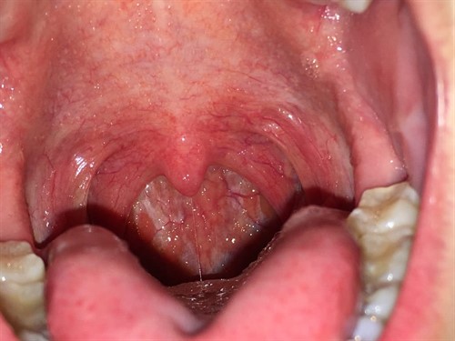 granulezniyfaringitfotosimptomiilechenie 05A09D09 - Гнойные язвочки во рту и причины их появления, а также виды болячек полости рта и их лечение