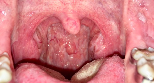 granulezniyfaringitfotosimptomiilechenie 5AE2CBD5 - Гранулезный фарингит: фото симптомы и лечение у взрослых