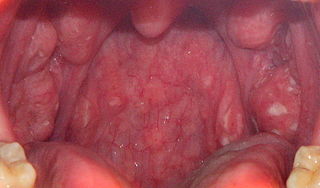 granulezniyfaringitfotosimptomiilechenie A229B70B - Гранулезный фарингит: фото симптомы и лечение у взрослых