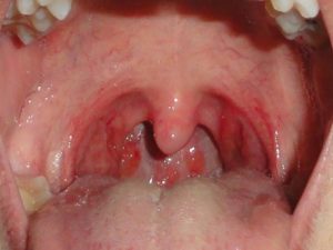 granulezniyfaringituvzroslixsimptomifoto 8336442F - Гранулезный фарингит у взрослых: симптомы, фото горла и лечение