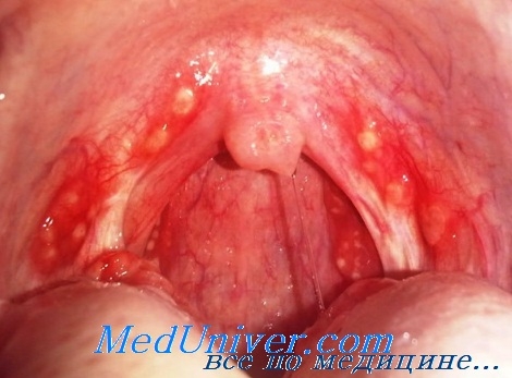 infektsiiverxnixdixatelnixputeyfaringito 88BC96B9 - Отличия синусита от ринита и других лор-заболеваний