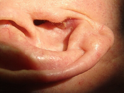 kaklechitnaruzhniyotitvzavisimostiotprir BCBBDA5F - Боль в ушах: почему возникает и как лечить