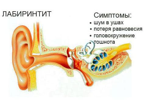 kaklechitotituxavdomashnixusloviyaxbolee 0650CF8A - Как лечить воспаление уха в домашних условиях: народные методы и медикаментозные препараты при отите