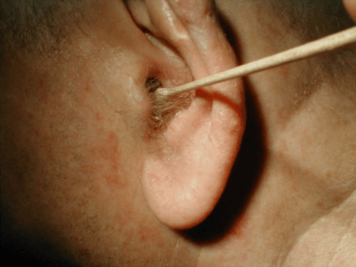 kaklechitotituxavdomashnixusloviyaxbolee 445372FC - Как лечить воспаление уха в домашних условиях: народные методы и медикаментозные препараты при отите