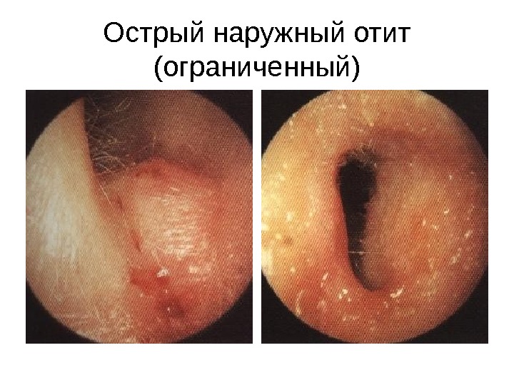 kaklechitotituxavdomashnixusloviyaxbolee 5C74CCD8 - Как лечить воспаление уха в домашних условиях: народные методы и медикаментозные препараты при отите