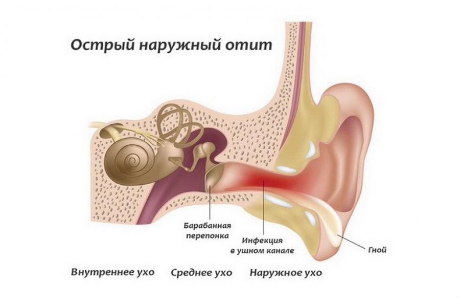 kaklechitotituxavdomashnixusloviyaxbolee F7E485D3 - Как лечить воспаление уха в домашних условиях: народные методы и медикаментозные препараты при отите
