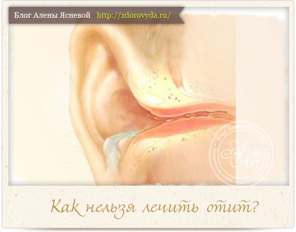 kaklechitotitvdomashnixusloviyaxbezopasn 6CD9C971 - Что делать можно при отите уха, а что запрещено и почему