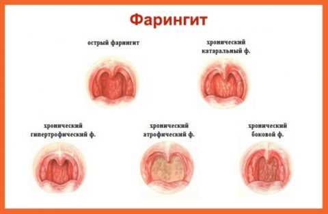 kaknavsegdaizbavitsyaotfaringitamylor 148017E9 - Симптомы острого тонзиллита