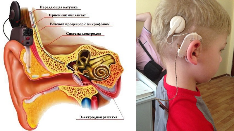 kakvosstanovitsluxposleotitaudeteyivzros 1FD570B4 - Как восстановить слух после отита: официальная медицина, упражнения для слуха, массаж
