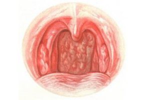 kataralniyfaringitprichinisimptomiileche 329B7C33 - Особенности гнойной ангины: как выглядит, симптомы и причины возникновения, способы лечения