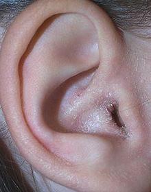 kataralniyotitsimptomidiagnostikailechen 33939603 - Отит среднего уха: симптомы и лечение, фото