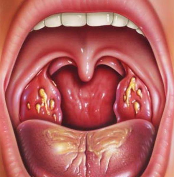 kodpomkb10ostriytonzillit B012B47C - Воспаление среднего уха у взрослых – причины, симптомы и лечение воспаления среднего уха
