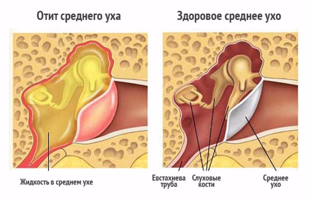 komarovskiyolecheniiostrogoisrednegoekss 464A70EB - Что такое экссудативный отит: симптомы, признаки, лечение