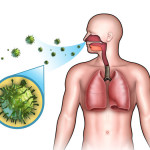 komarovskiysimptomiilecheniefaringitavid C3AE47A8 - Золотистый стафилококк в горле лечение: пути инфицирования, виды, как лечить