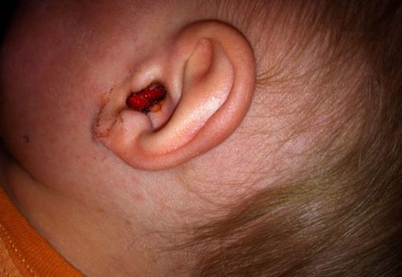 krovizuxapriotiteprichiniilechenie 939FD328 - Кровь из уха — причины и лечение кровотечений ушей