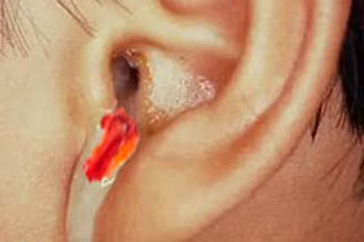 krovizuxapriotiteprichiniilechenie 9F36787D - Кровь из уха — причины и лечение кровотечений ушей