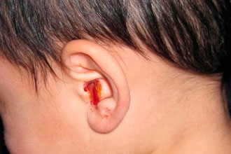 krovizuxapriotiteprichiniilechenie D33B0E9A - Кровь из уха — причины и лечение кровотечений ушей