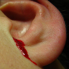 krovizuxapriotiteurebenkaivzroslixscheme 3B1E35FD - Кровь из уха — причины и лечение кровотечений ушей