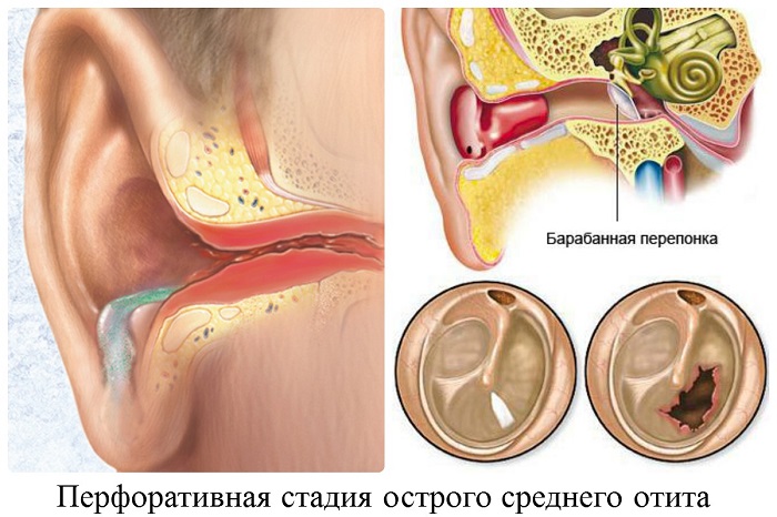 krovizuxapriotiteuvzroslix 365C7FEA - Кровь из уха — причины и лечение кровотечений ушей