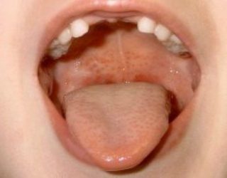lecheniefaringitaudeteypokomarovskomucht 07DB519F - Особенности лечения хлоргексидином для полоскания рта: действие, инструкция по применению, показания