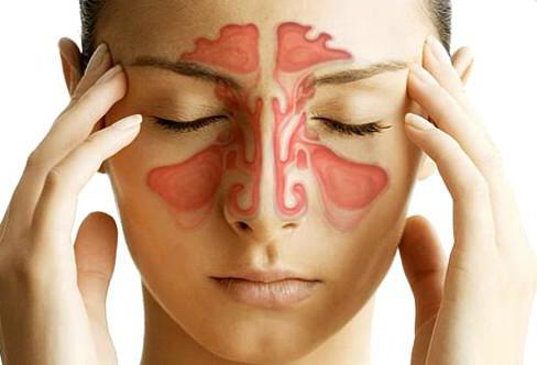 lechenieostrogosinusitavdomashnixusloviy EBF643F4 - Острый синусит – инфекционное заболевание околоносовых воздушных полостей — пазух носа