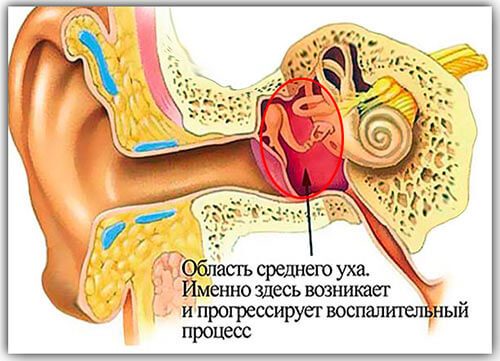 lechenieotitauvzroslixvdomashnixusloviya 110A89DF - Как лечить воспаление уха в домашних условиях: народные методы и медикаментозные препараты при отите